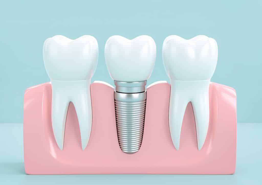 dental implants chattanooga tn