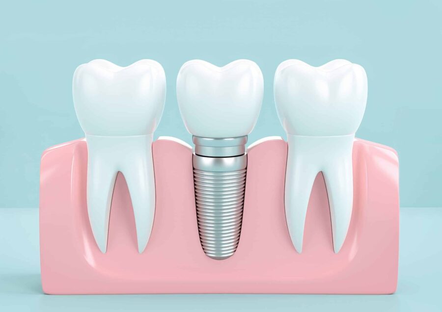 dental implants chattanooga tn