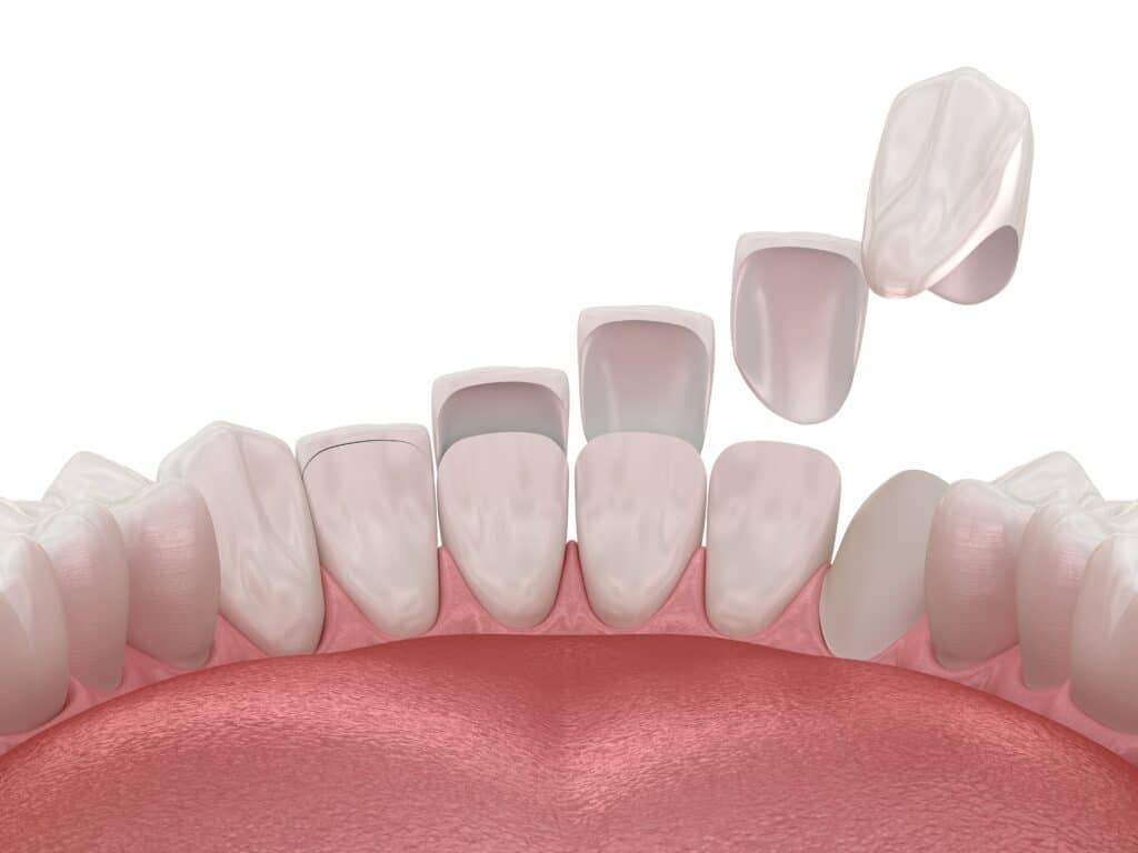 Minimal Prep Veneers Chattanooga