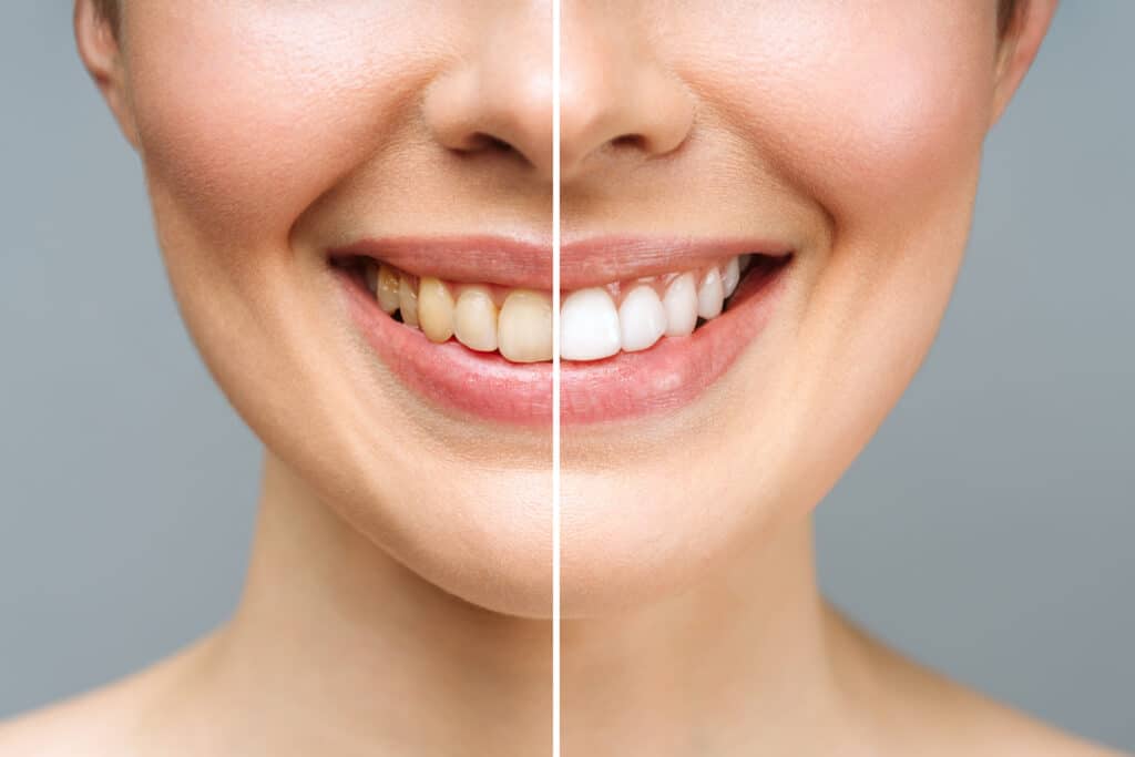 Before and After Veneers