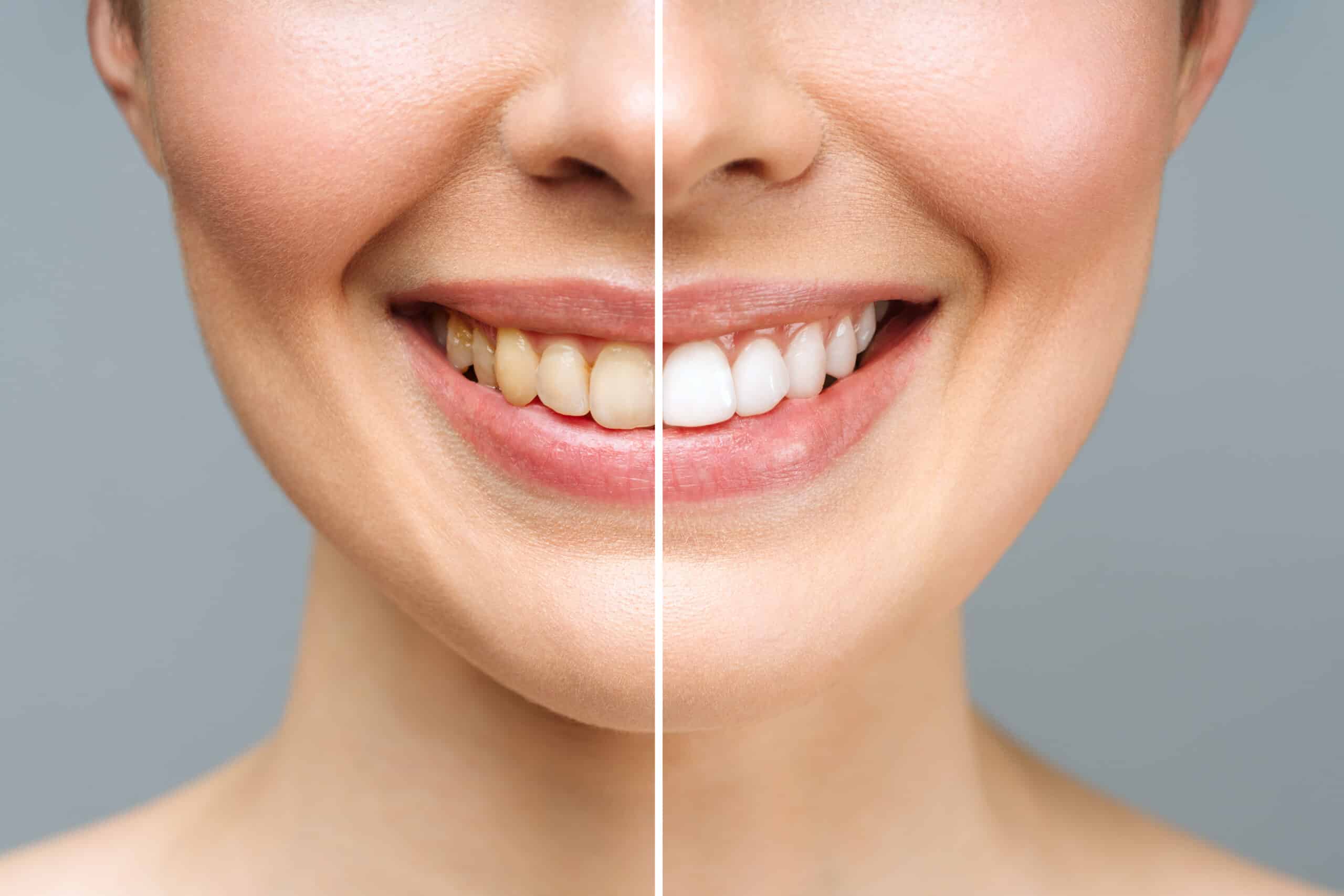 Before and After Veneers